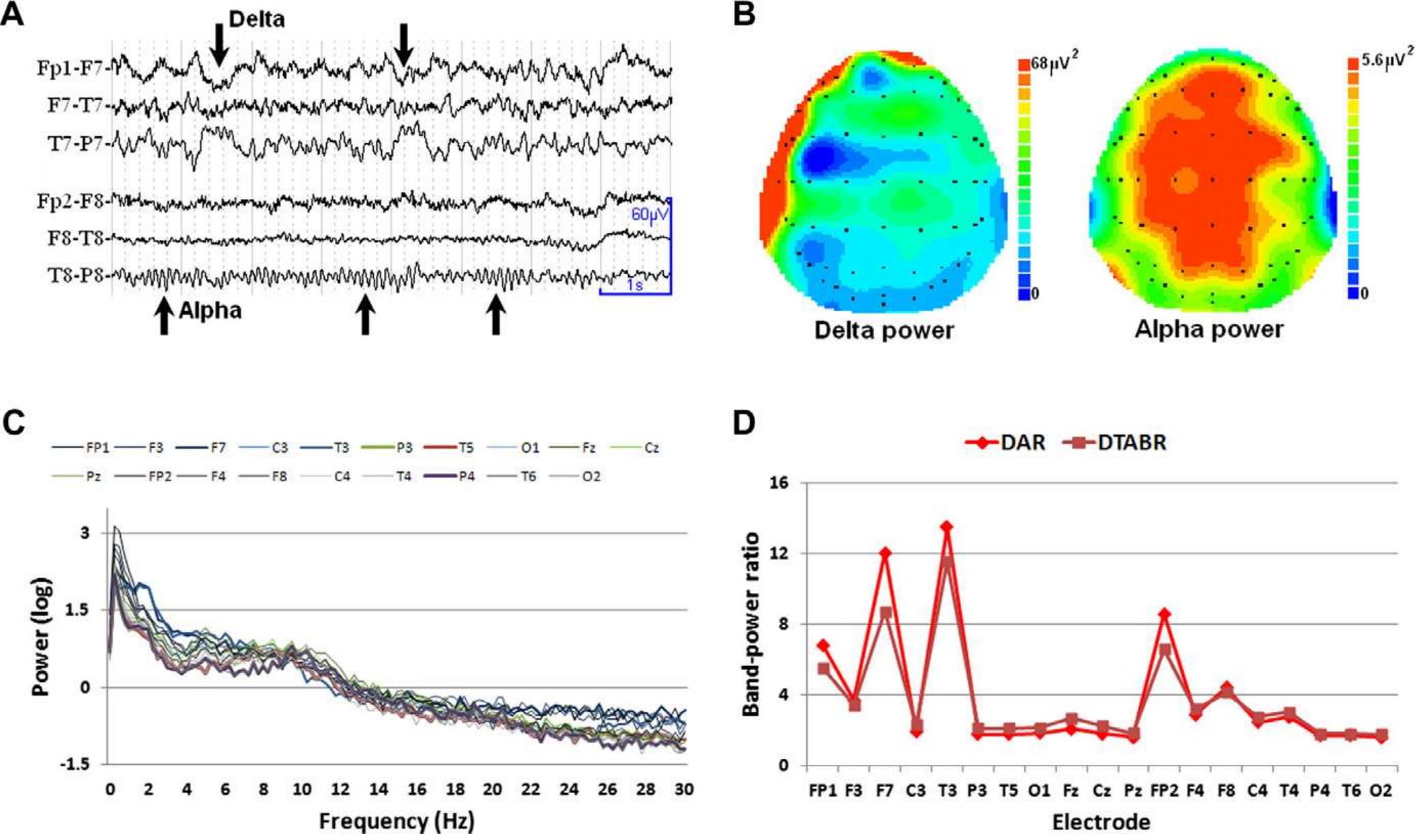 (PDF) EEG in ischaemic stroke: quantitative EEG can uniquely inform ...