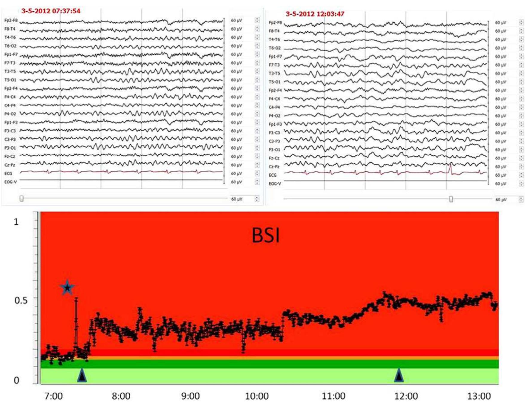 (PDF) EEG in ischaemic stroke: quantitative EEG can uniquely inform ...