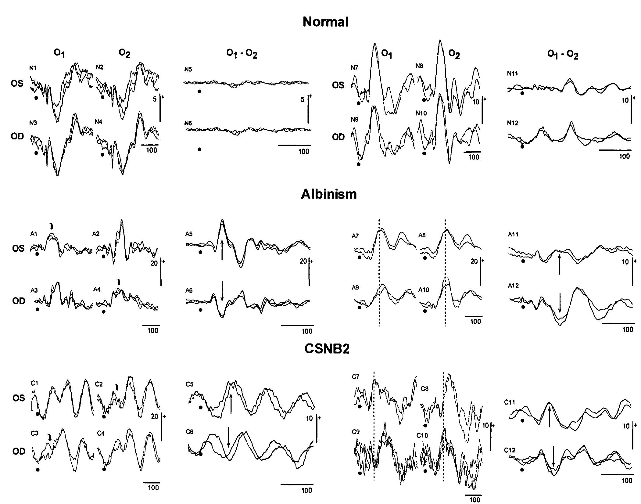 (PDF) Visual Evoked Potentials With Crossed Asymmetry in Incomplete ...