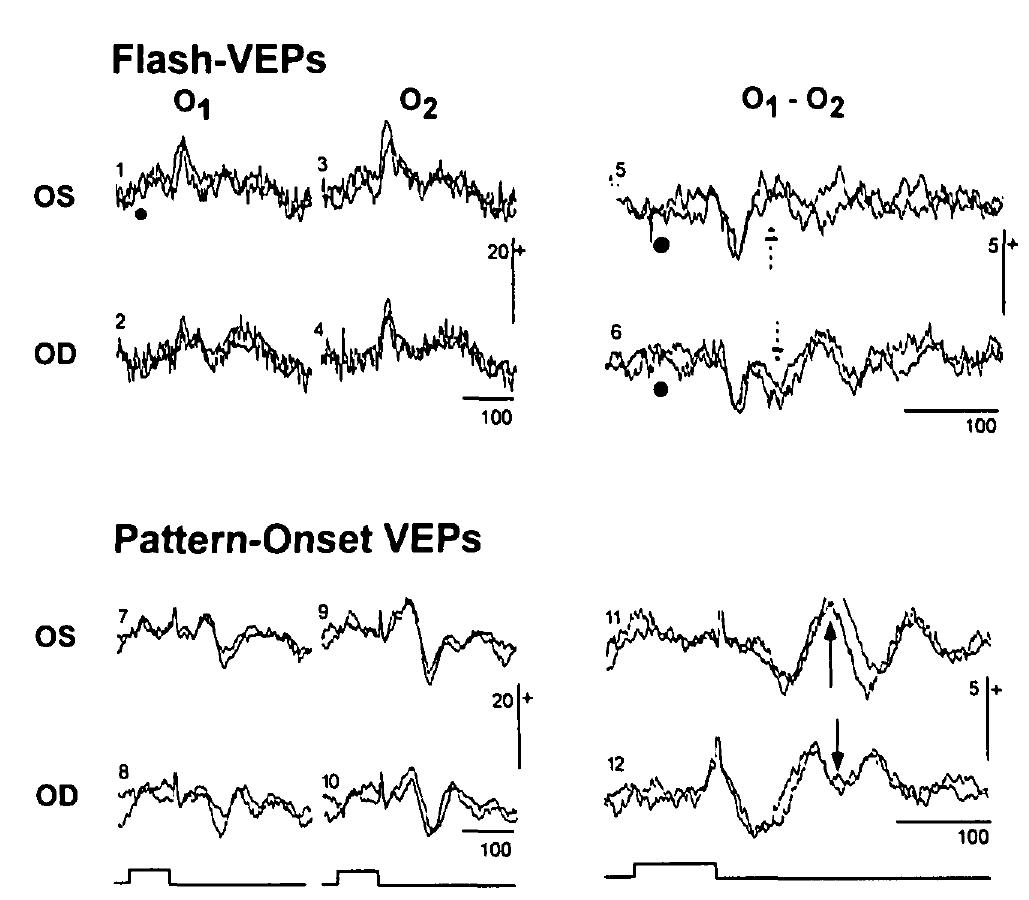 (PDF) Visual Evoked Potentials With Crossed Asymmetry in Incomplete ...