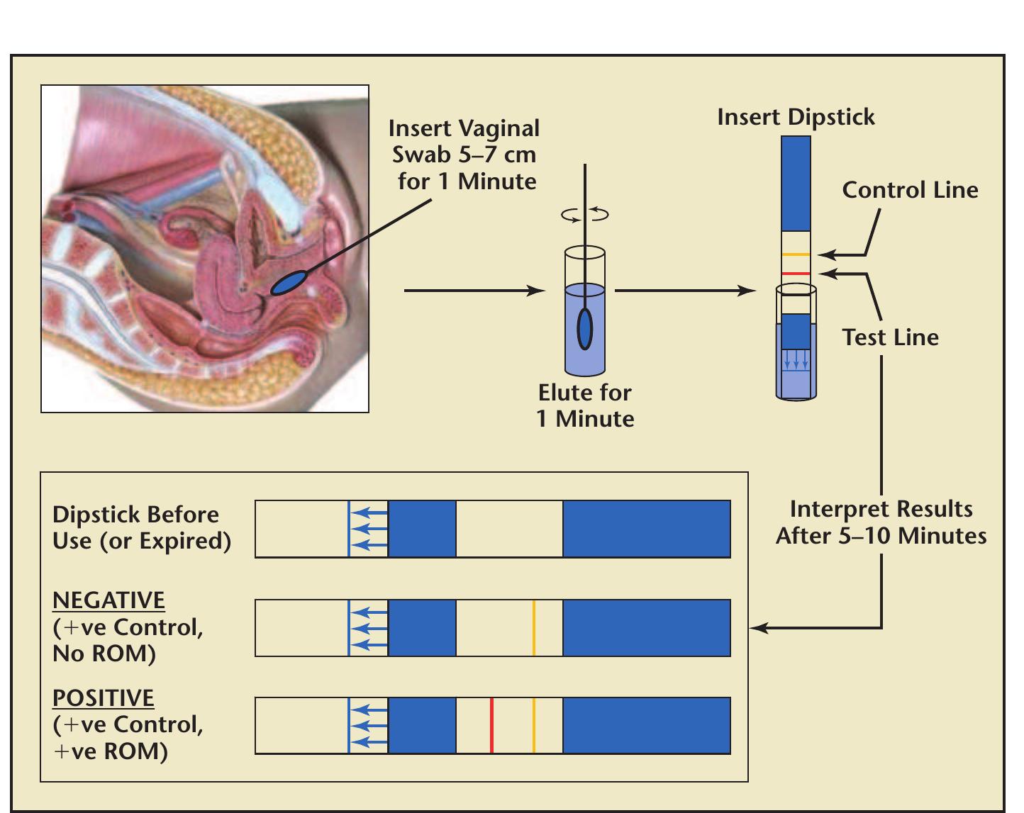 Rom Swab (PDF) Amnio sure