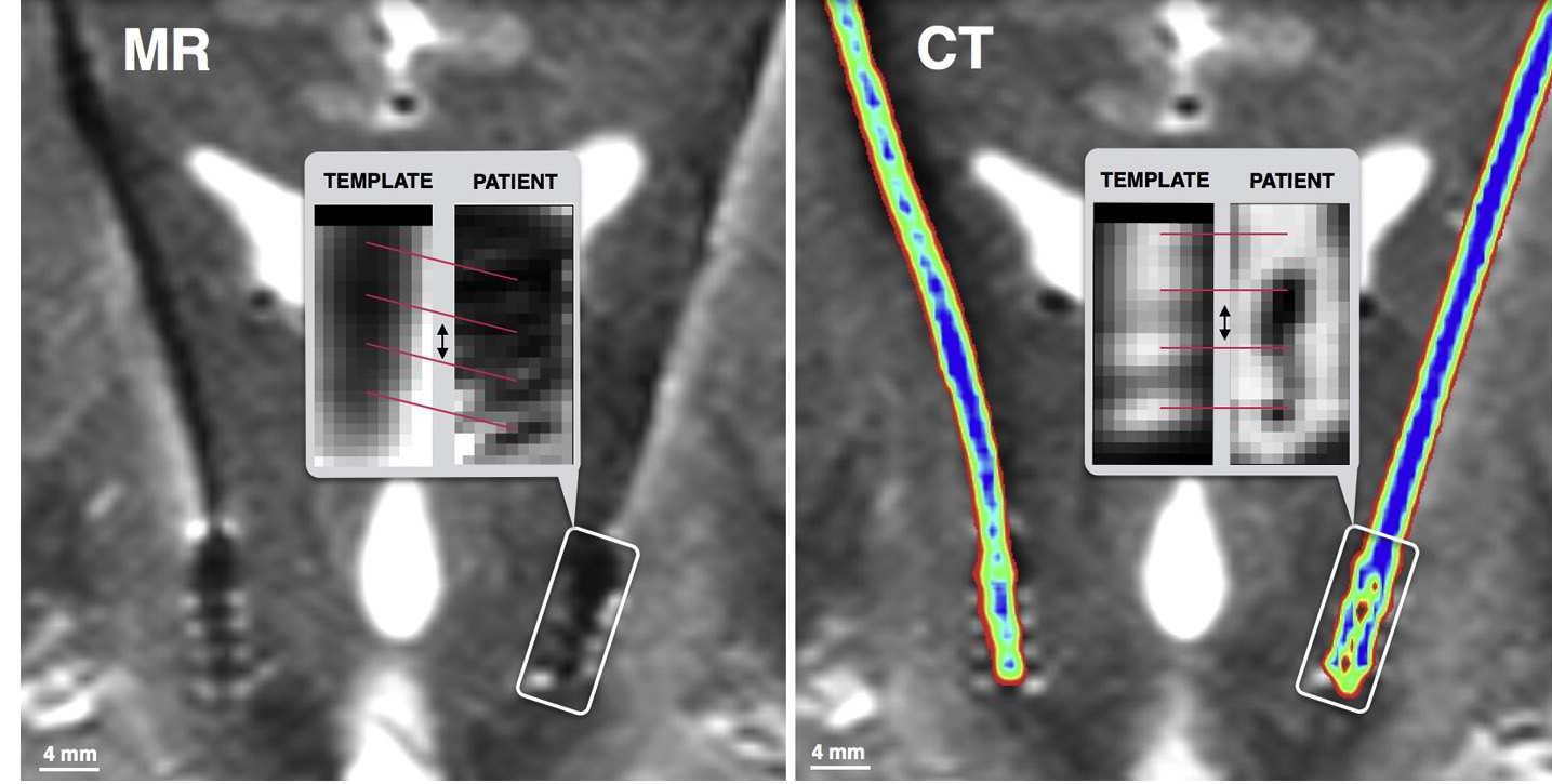 (PDF) Lead-DBS: A toolbox for deep brain stimulation electrode ...