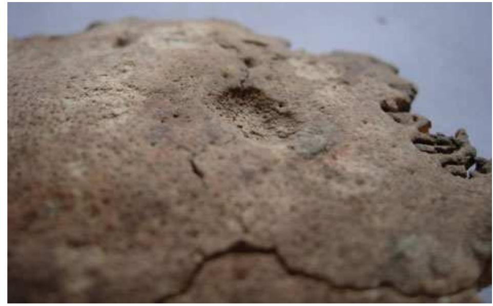 Figure 8 Healed depressed cranial fracture from Area MTW. 