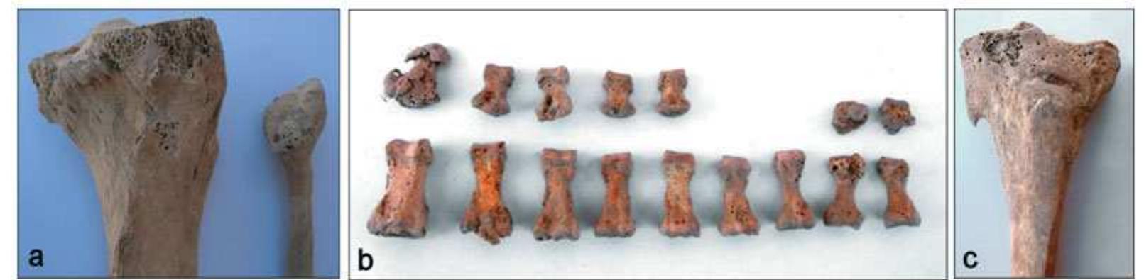 Figure 4. Healed trauma: a) knee. A false joint probably developed following a dislocation of the right fibula-tibia. The proximal articular surface of the right fibula is deformed; it matches a similar area below the normal articular facet on the tibia. The distal end of the right fibula has a slightly anomalous shortened articulation. There is healed periostitis of the distal shafi; b) toe bones: small pits on the plantar surface of the middle phalanges of right and left second toes could be claw toes due to persistent hyper-flexing. One toe also has signs of an ossified ligament presumably following trauma. The right fifth toe is deformed as a result of trauma; c) tibia with enthesopathy or bony spur following injury. 