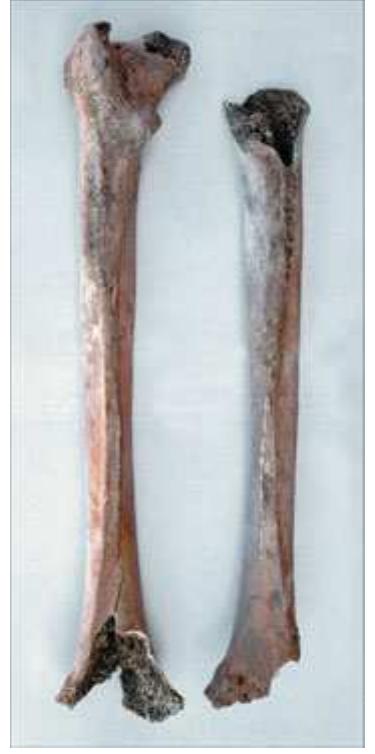 Figure 5. Thigh bones, dorsal aspect of left and right femur shafis. There are strong impres- sions on both for attachment of gluteus maximus. A well- developed attachment area for the medial head of gastrocnemius is seen on the right femur, just  above the knee; the left has a well  marked line for vastus medialis.  Cdll CLIVE! TPO) UL UVIOHESOI OC LLIOU SSO LAZO).  The calcaneus bone of the right heel (the left is incomplete) has a bony spur or enthesis where the Achilles tendon attaches. This together with strongly developed muscle and ligament attachments on the toes of both feet is interpreted as resulting from habitual and energetic activity. The latter are best seen on the left foot, the changes to the right foot being modified by the consequences of injury. The ligament imprints on the toes suggest that the toes were strongly flexed persistently, with the result that pits developed in the plantar 