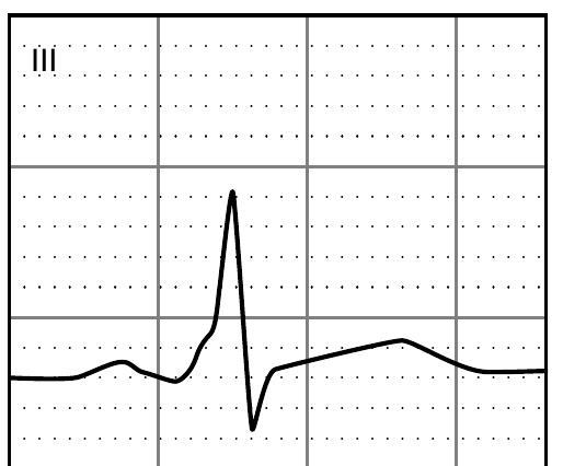 Figure 34 - from ECG interpretation