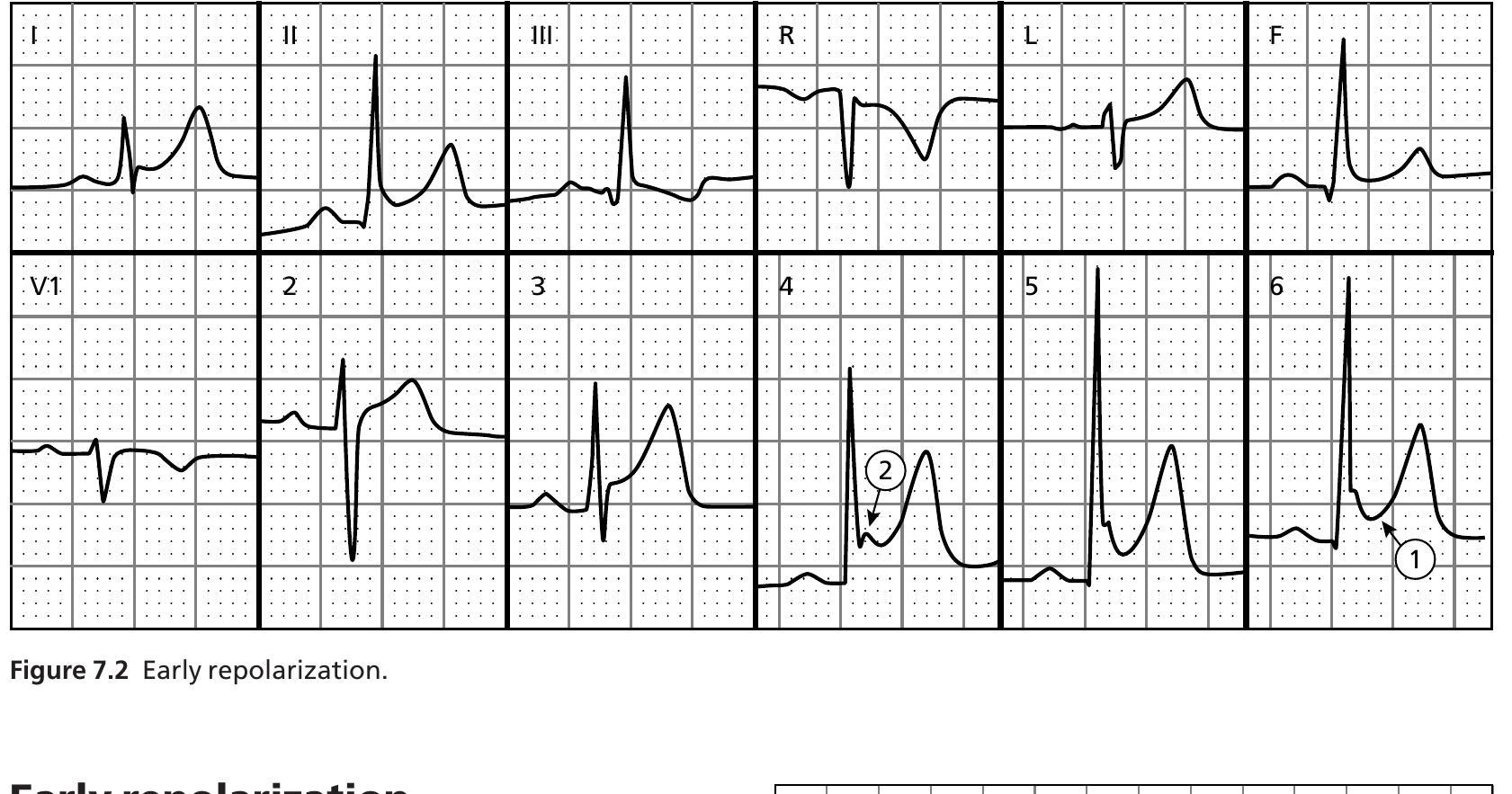 (PDF) ECG interpretation