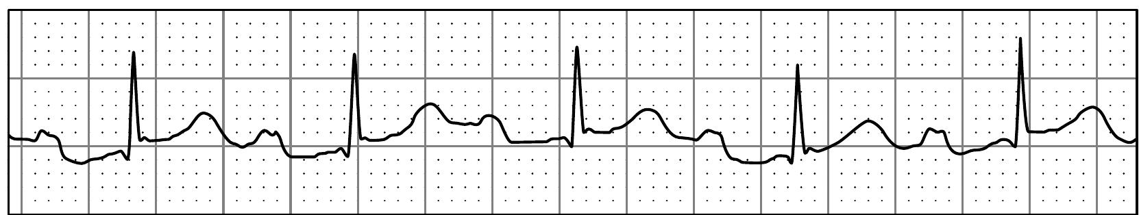 Figure 117 - from ECG interpretation