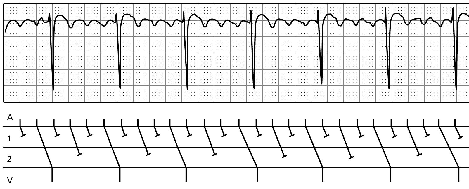 Figure 130 - from ECG interpretation