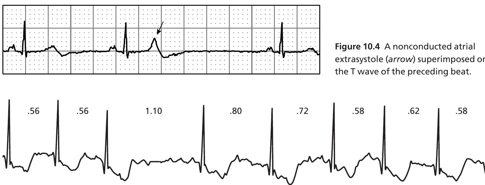 5 atrial fibrillation: the r-r intervals are irregularly