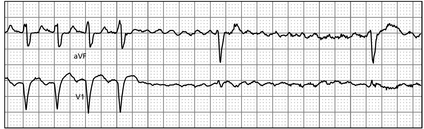 Inverted A Flutter 12 a rapid bolus of adenosine reveals low-amplitude atrial
