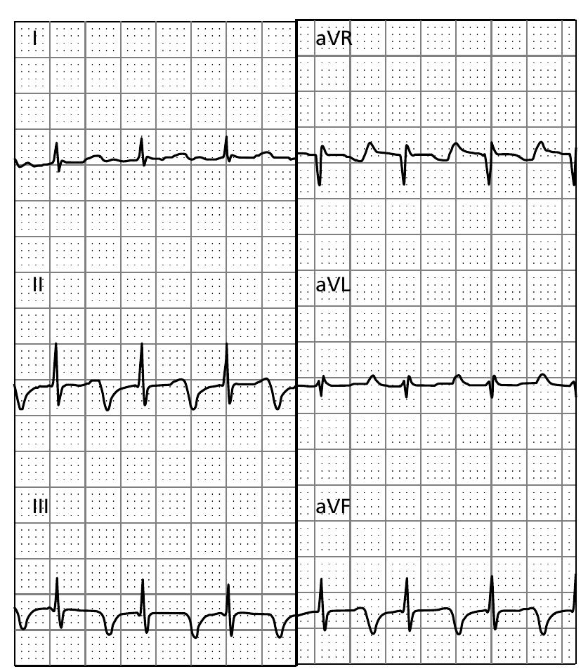Figure 191 - from ECG interpretation