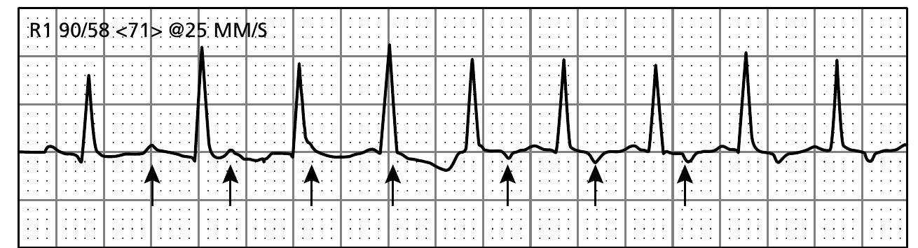 14 atrial tachycardia switches to avrt. ventriculoatrial