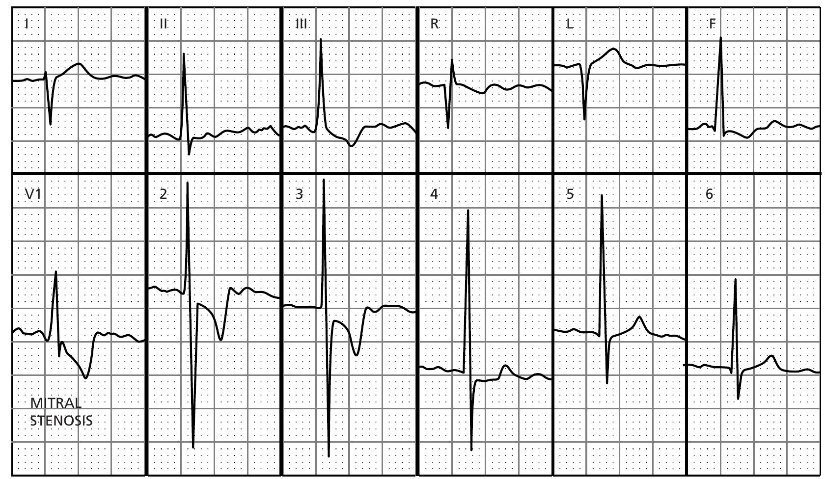 Figure 313 - ECG interpretation