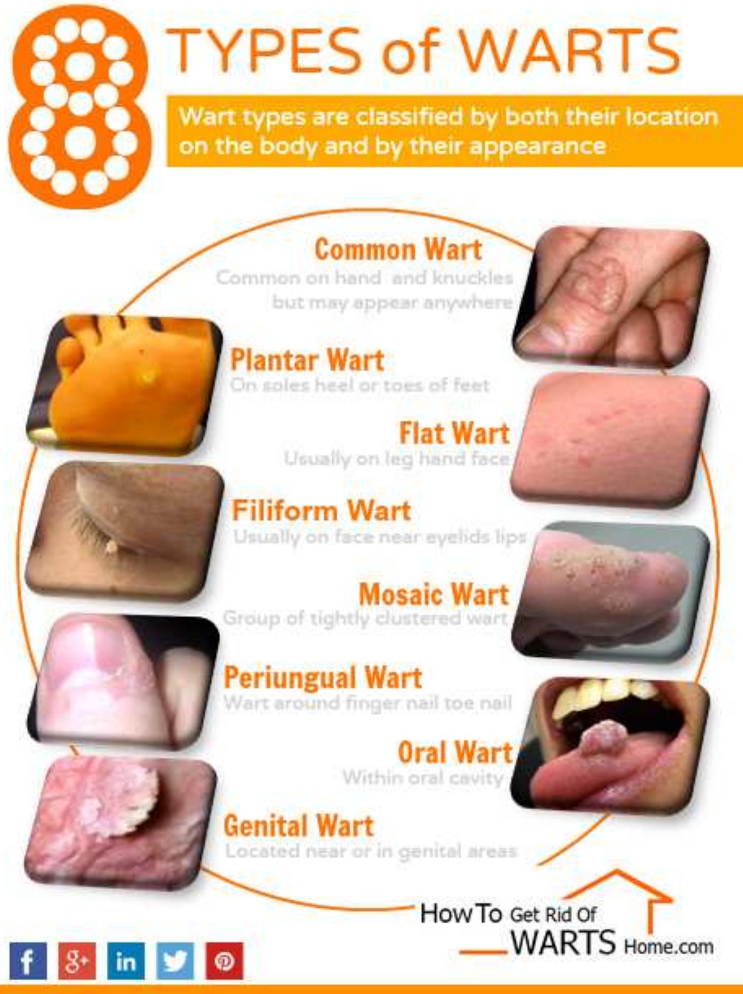  PDF Types Of Warts How To Identify All 8 Of Them