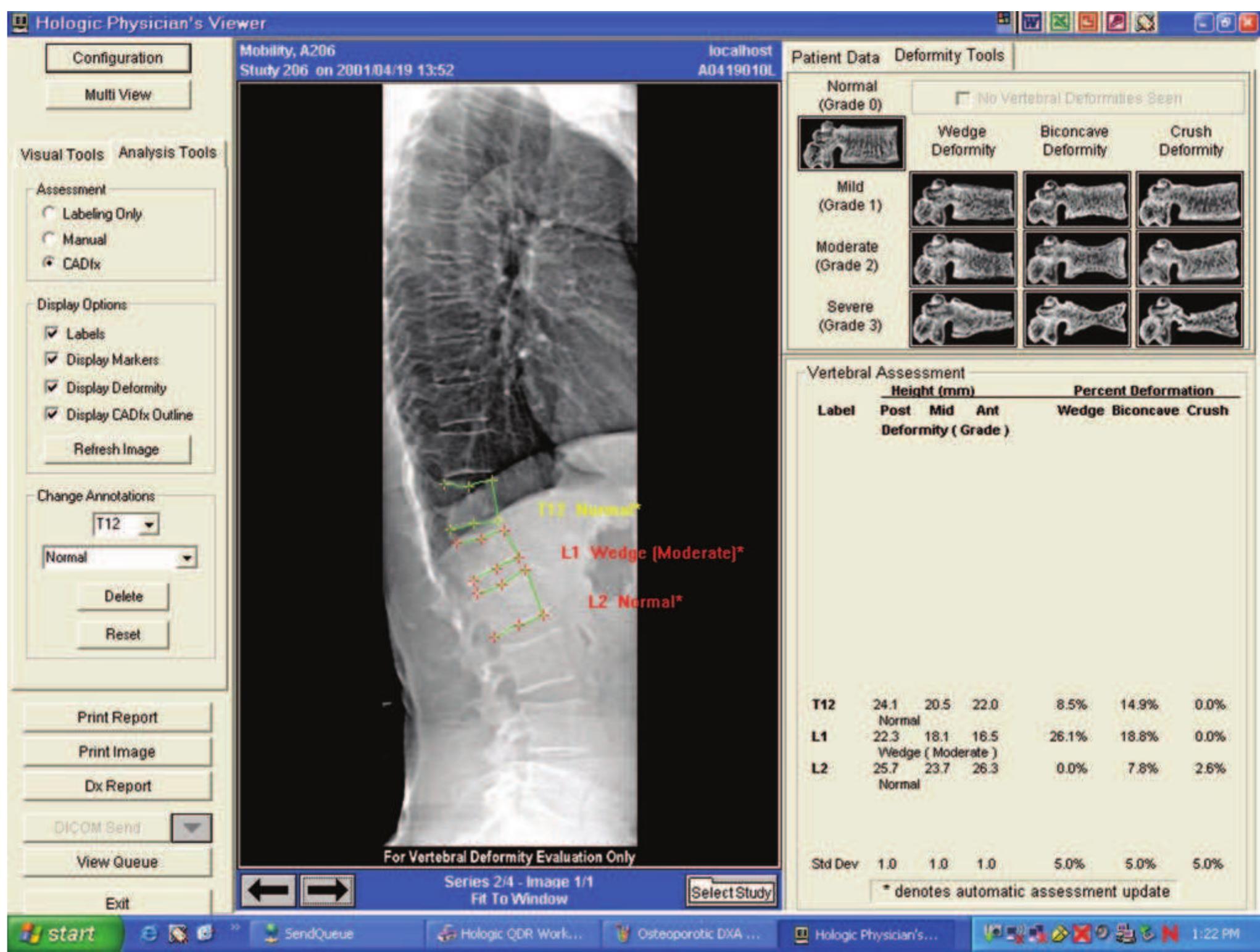 Lateral Scan 16 lateral spine scan showing vertebral deformity