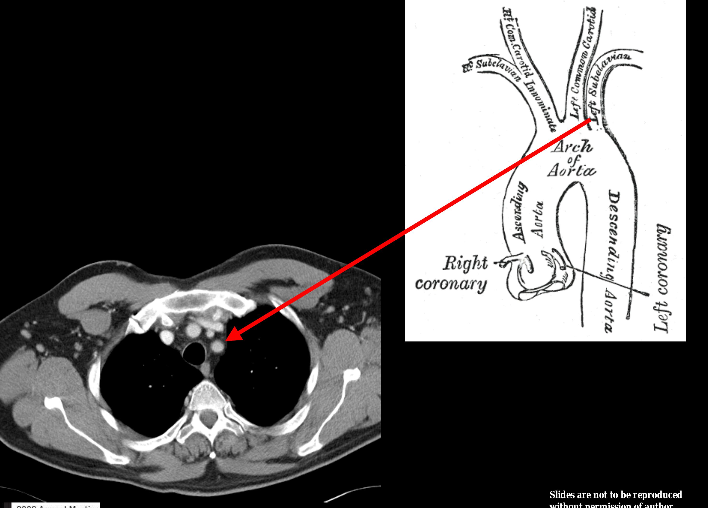 Figure 71 - from Cross Sectional Anatomy of the Chest,