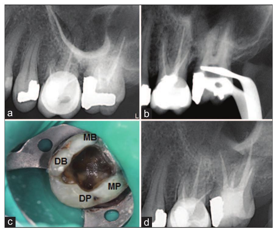 Figure 1 - from Double palatal roots in maxillary second