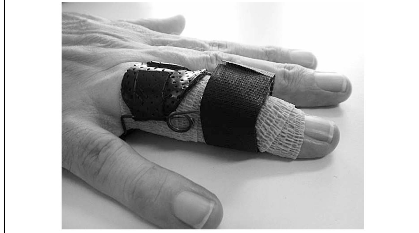 Dynamic capner splint used to improve proximal