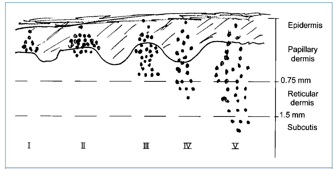 -12. staging of melanoma according to clark. level |: tumor