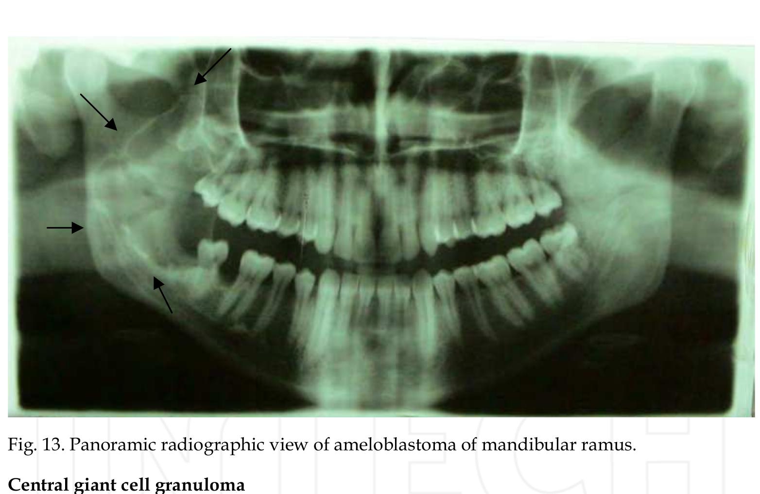 Ameloblastoma are most common tumors of jaws. the majority