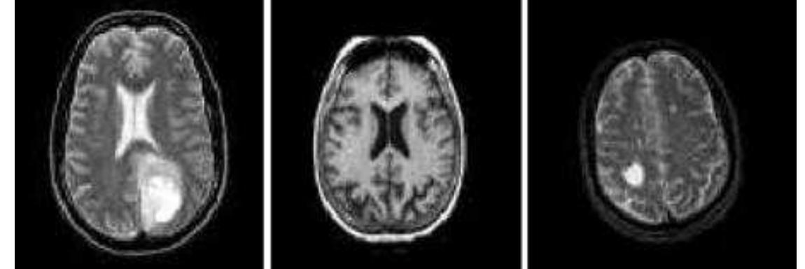 (PDF) Classification of MRI Brain Image using SVM Classifier