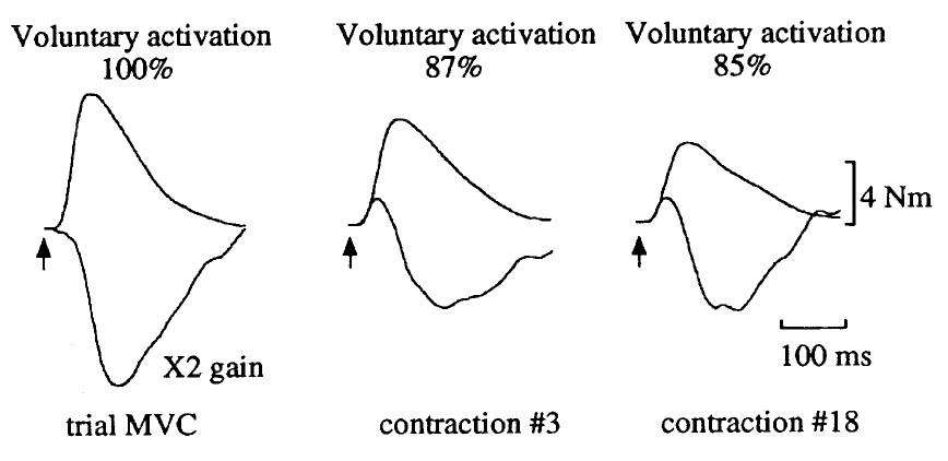 Fig. 5. Force tracings from one subject during a fatigue protocol (50% duty cycle). Upper tracings show the twitch force evoked by a supramaximal paired stimuli (10 ms interval) in the relaxed muscle. The lower tracings (increased gain; x 2) show the force response to the same stimulation delivered during a MVC. In the trial (control) MVC, no force increment was seen in the twitch interpolated on the MVC. After three and even more clearly after 18 contractions, the relaxed twitch declined, while the interpolated twitch force  This illustrates the simultaneous development of both peripheral and  increasing target force upon which the stimulation was superimposed. This relationship, which is obtained in the unfatigued state, can be extrapolated to a fatiguing situation in which the maximal force falls. The twitch superimposed on a given target force level may thus be used to estimate the generated force relative to the current maximal force. More recently Gandevia and McKenzie (1988) have refined the method and obtained a more sensitive assessment of the twitch force superim- posed on the voluntary contraction. They report that even though conventional twitch interpolation tech- niques indicate no central fatigue or difference between maximal voluntary and maximal evocable force, a dif- ference of about 5% may be present. As shown in Fig. 5, the force generated in response to a pair of supra- maximal stimuli given to relaxed muscle (upper curves) fell gradually with repeated MVCs (Gandevia, 1995). In contrast, the force response to the same stimulation 