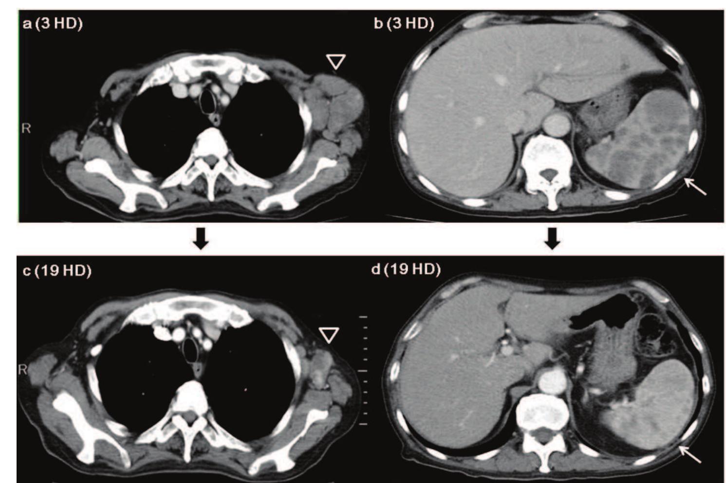 Aspiration cytology of left axillary lymph nodes. as-