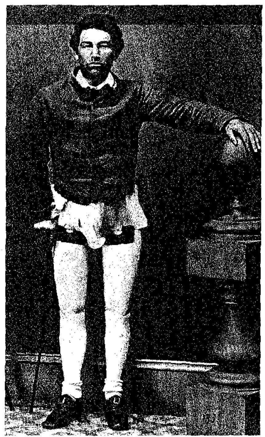 Without modern medicine, amputation was the only recourse for thousands of wounded during the war. Here Columbus Rush poses with his two artificial legs, 1866. 