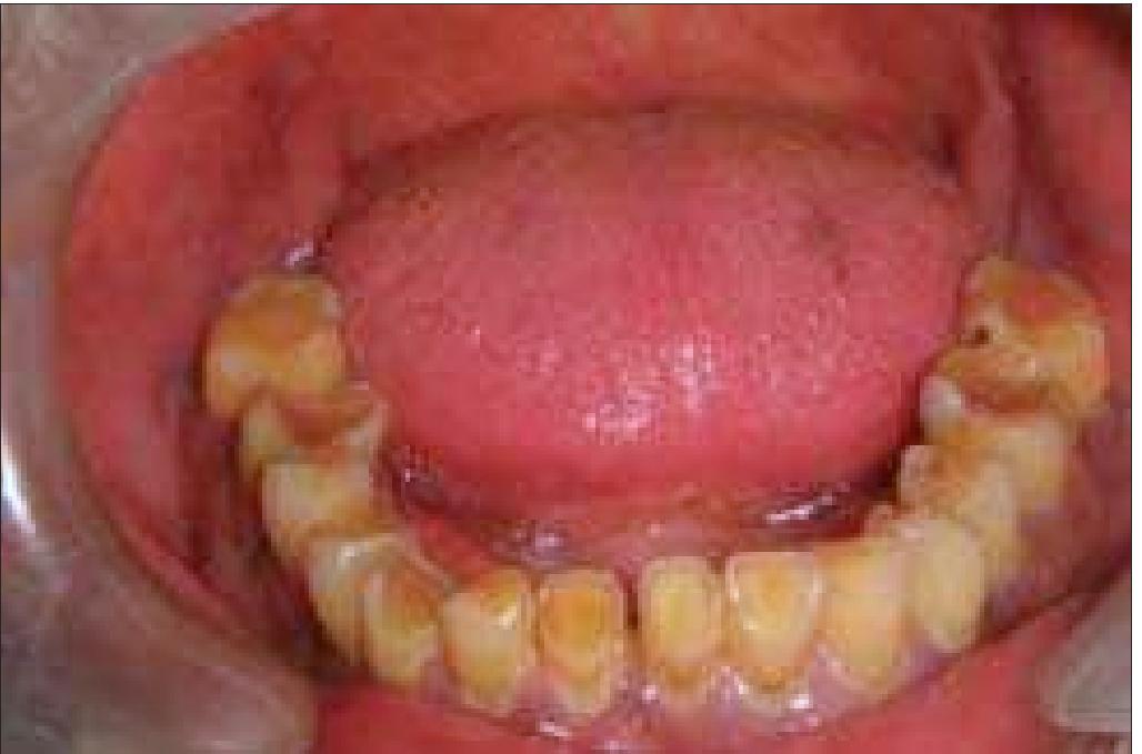 (PDF) The removable occlusal overlay splint in the management of tooth wear