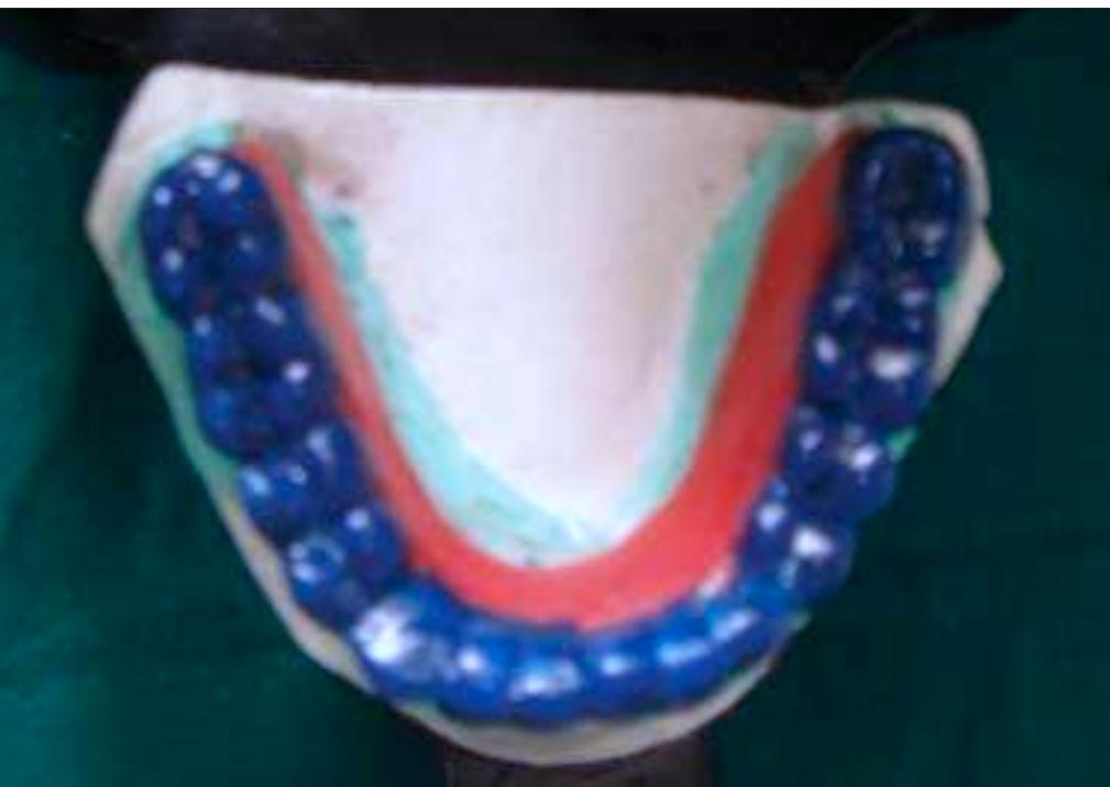 (PDF) The removable occlusal overlay splint in the management of tooth wear