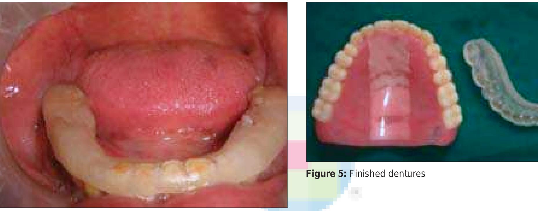 (PDF) The removable occlusal overlay splint in the management of tooth wear