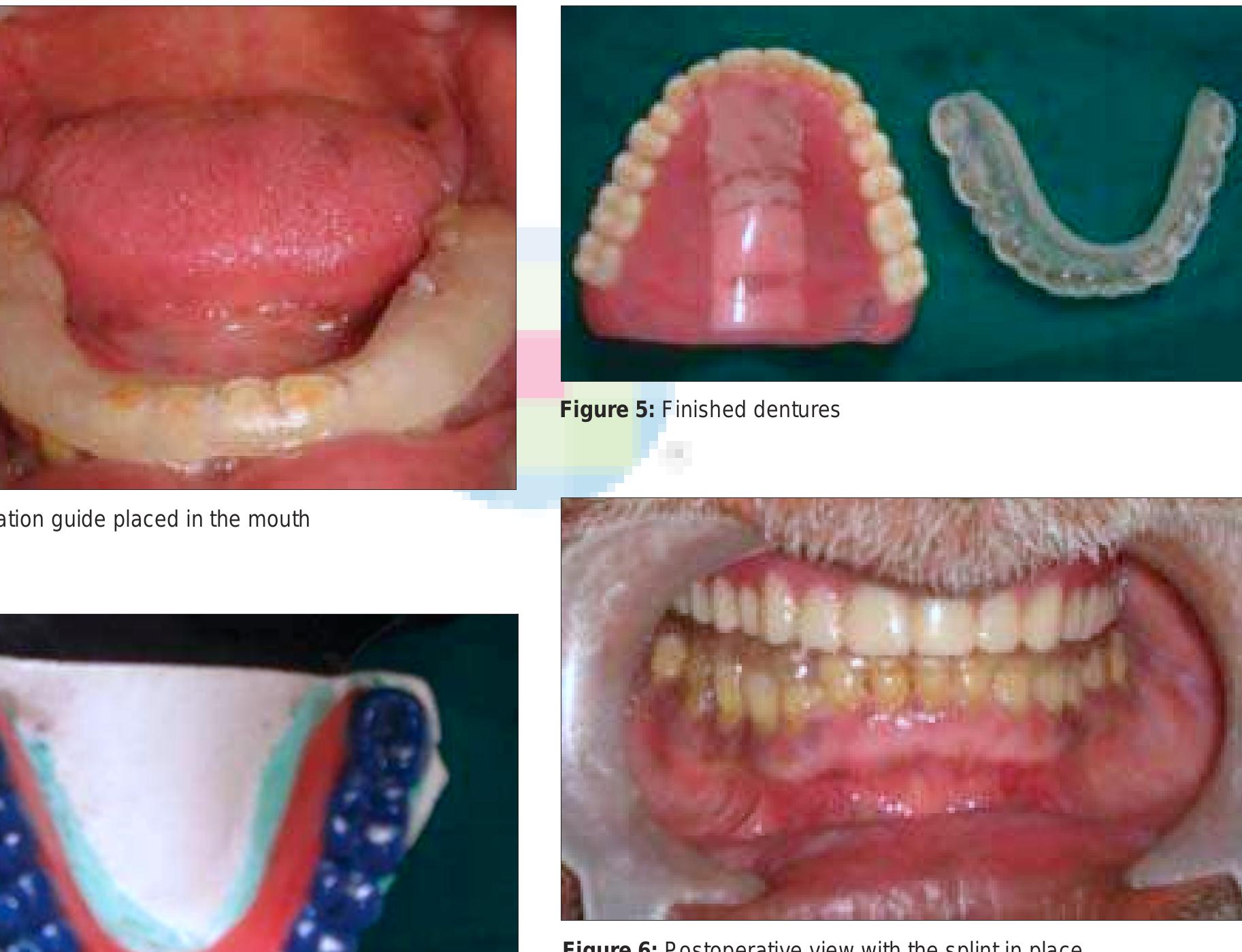 Figure 4 - from The removable occlusal overlay splint in the