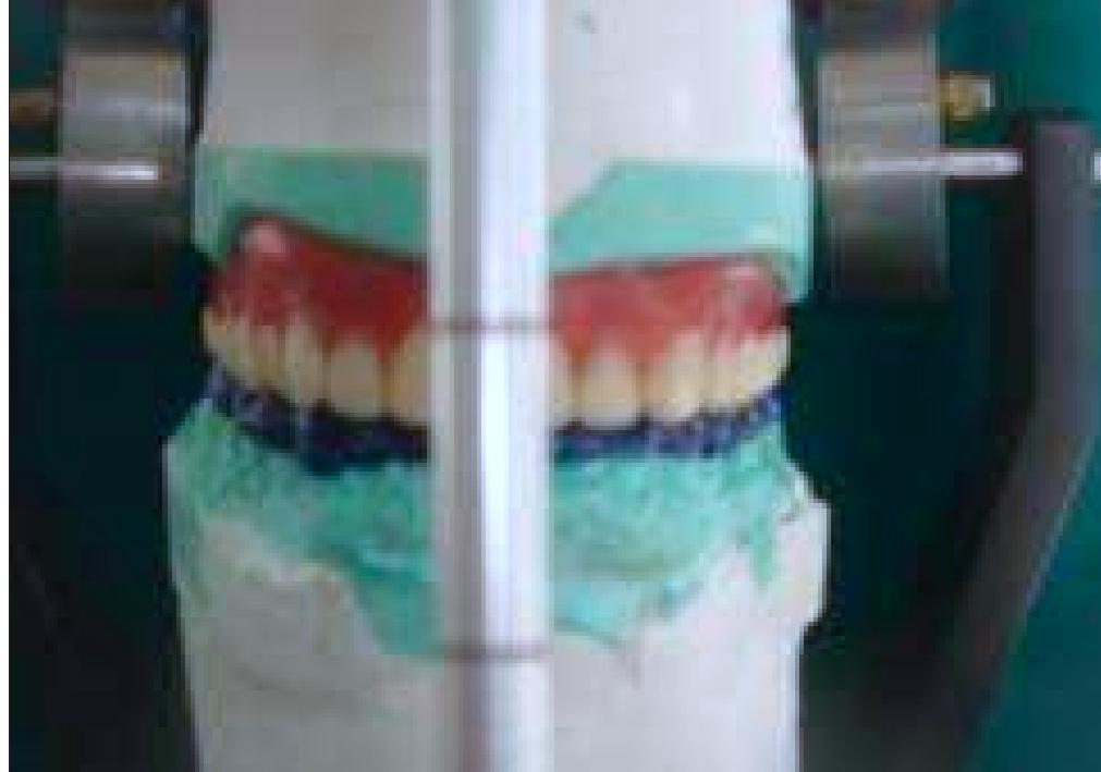 (PDF) The removable occlusal overlay splint in the management of tooth wear