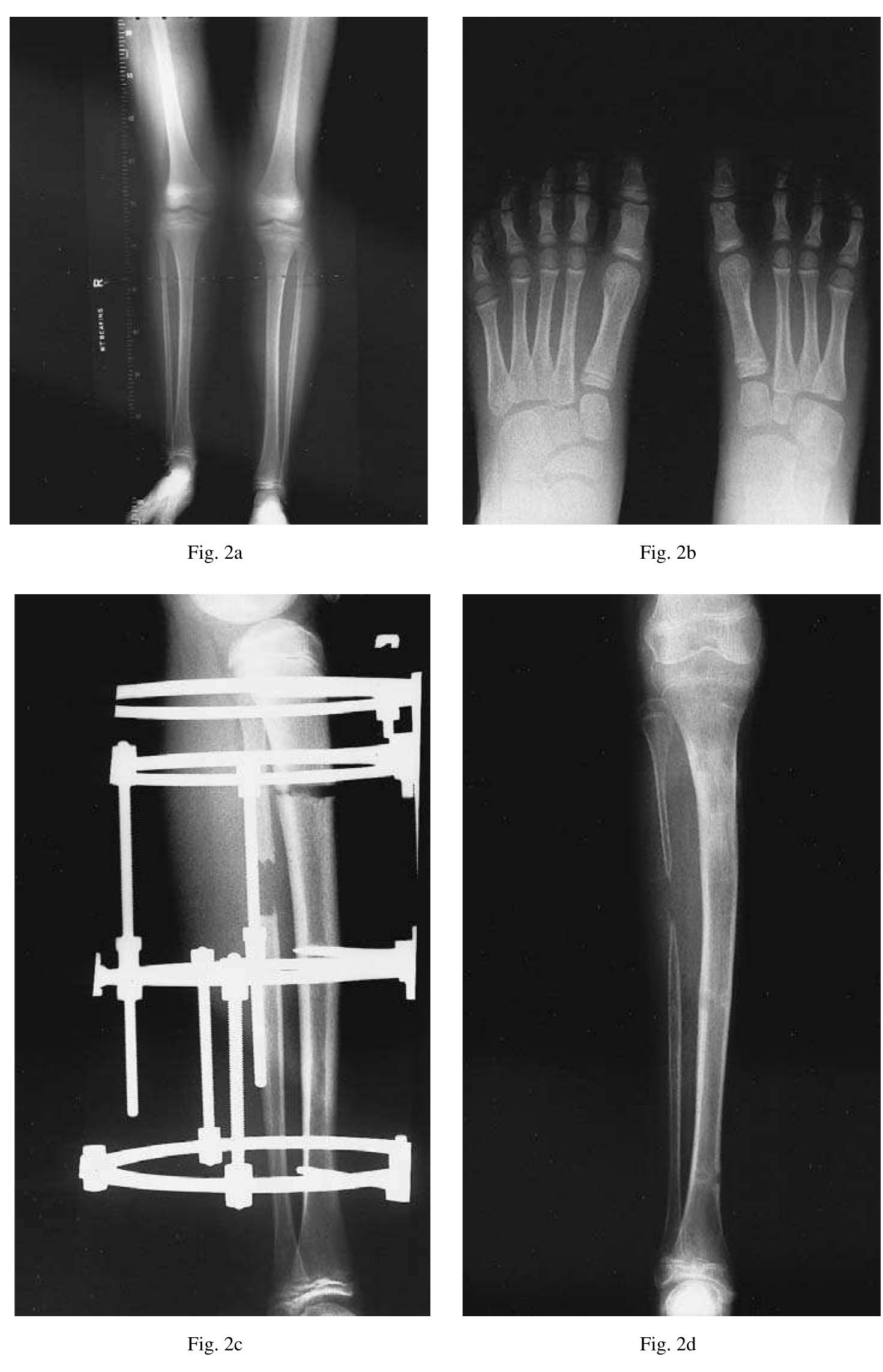 Case 15. figure 2a — preoperative standing radiograph of a