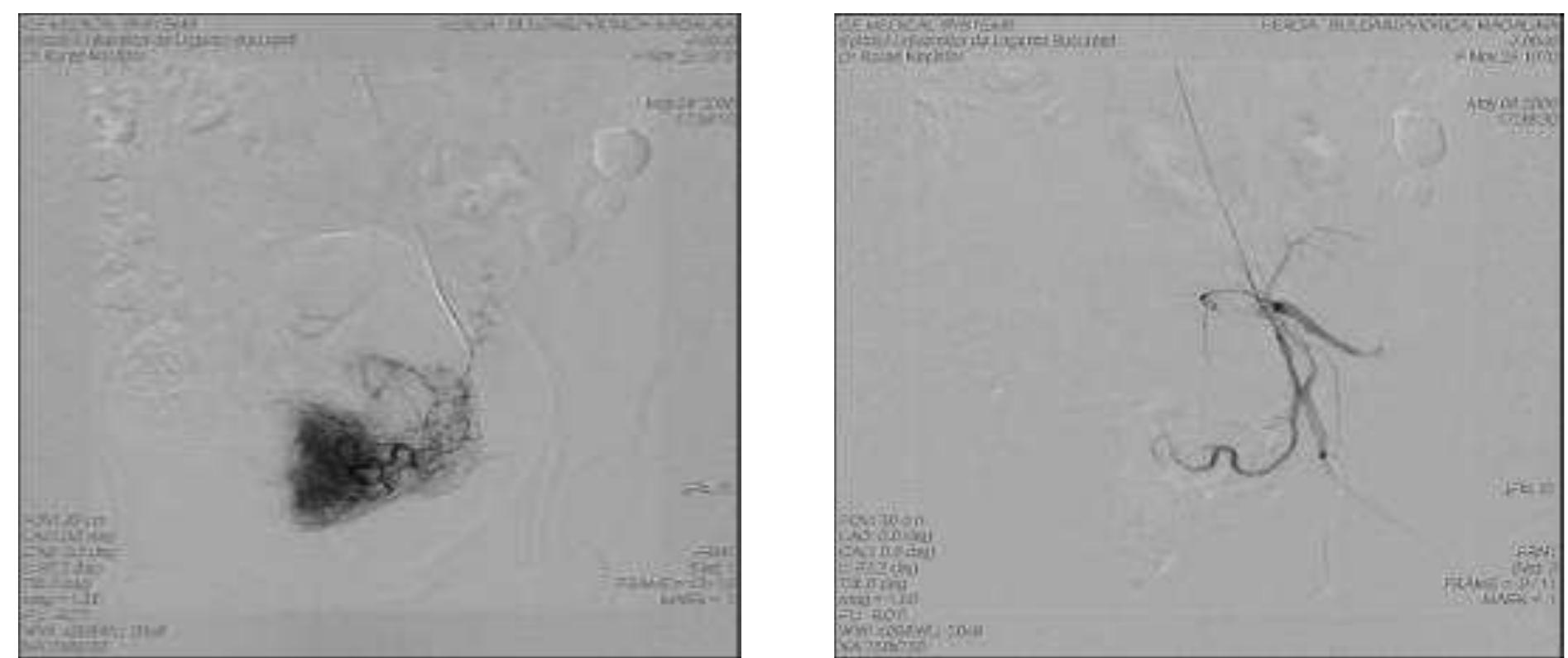 Figure 4 — Left tubal pregnancy — ovarian and uterine artery embolization (intraprocedural aspect) 