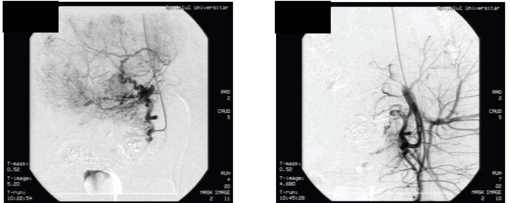 Figure 1.— Uterine artery embolization of a voluminous leiomyoma (intra-procedural aspect)  Uterine artery embolization implies the injection through a catheter placed in the brachial artery or femoral artery of small particles aimed to obstruct the vessels that supply the uterine leiomyoma.!° The procedure was performed under local anesthesia in the Invasive Radiology Department and it usually took less than one hour.  ebLE Ne © Se ERs EE REE bD AG SLENC SE MO DS ENG Et BUM Vboskie al pain and other symptoms required the admini  inflam antiemetic m intense. The pump (PCA orally. Usual reason for p m oving, noi terine in ephalospori  Qs  TT ._. ._... ..2. bg. 12.1... 2h. . 2  Manage matory drugs, analgesics and op n the first 6 hou  ment of  ication i { response ith fentany the pain nging  notes  was obtained i  tinal or urinary tract prob fection was made using an n and metronidazole. More fter 1-2 days after the intervention.  An 1.... ......4°..  associated wi  ioids given i  uring hospitali ems and, of course, no inci  tibiotics such  ntravenously.  rs aS vomiting occurred an n patients who used a patient co th anti-inflammatory drugs taken decreased gradual ly after 24-48 hours. Persi hospitalization. D  zation, patie  Q TiprOld Wssue. stration of ant  Patients also require d as pain became mot ntrolled analgesi intravenously sting pain was the mai nts had no restriction i  as ampicil  than 80 % of patients were re  sions. Protection again: lin and gentamicin eased from hospit  