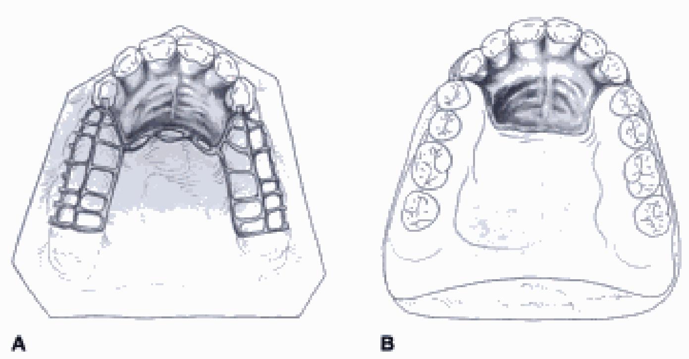 Mccracken Protesis Parcial Removible 11 Edicion www.academia.edu