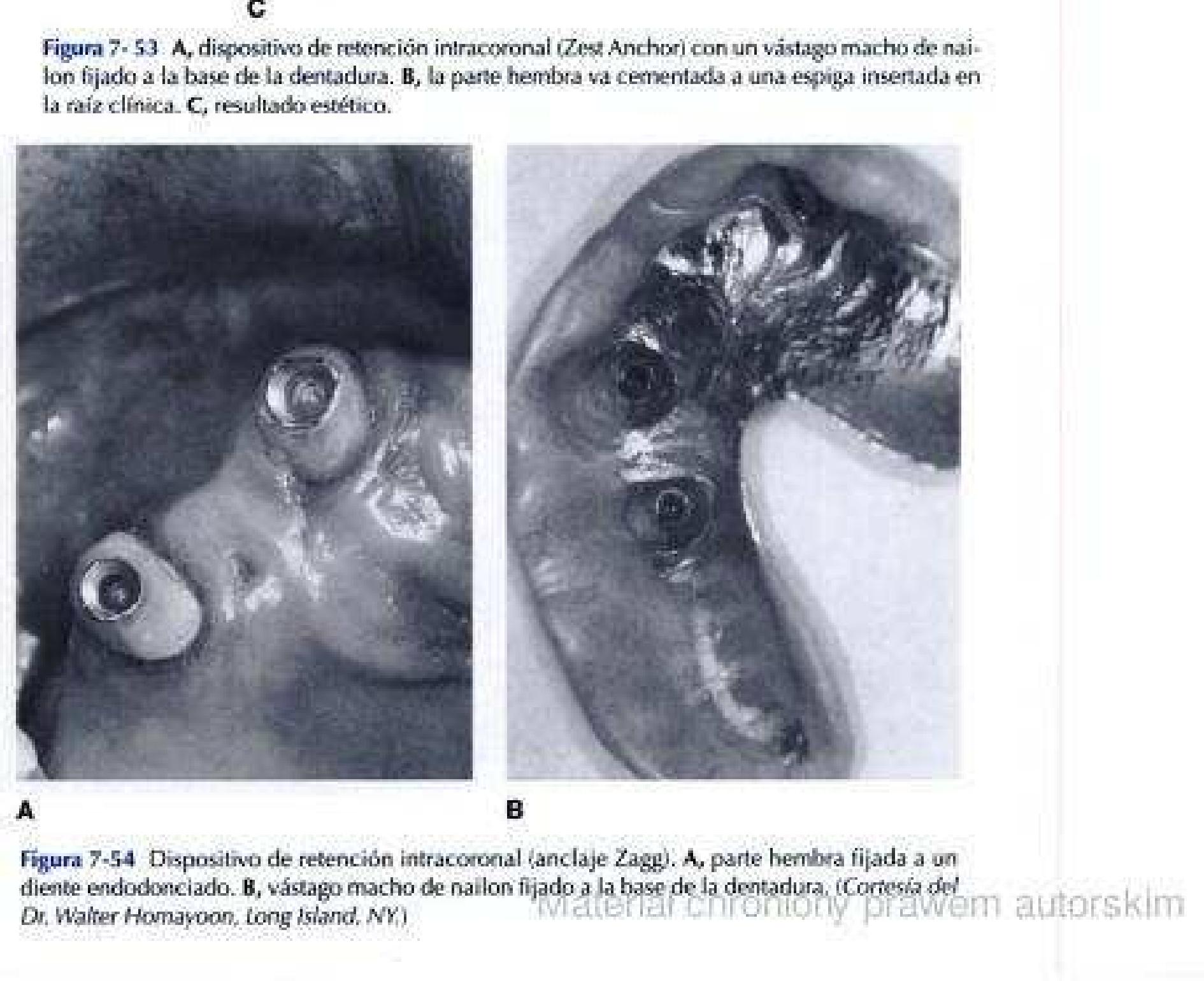 Mccracken Protesis Parcial Removible 11 Edicion www.academia.edu