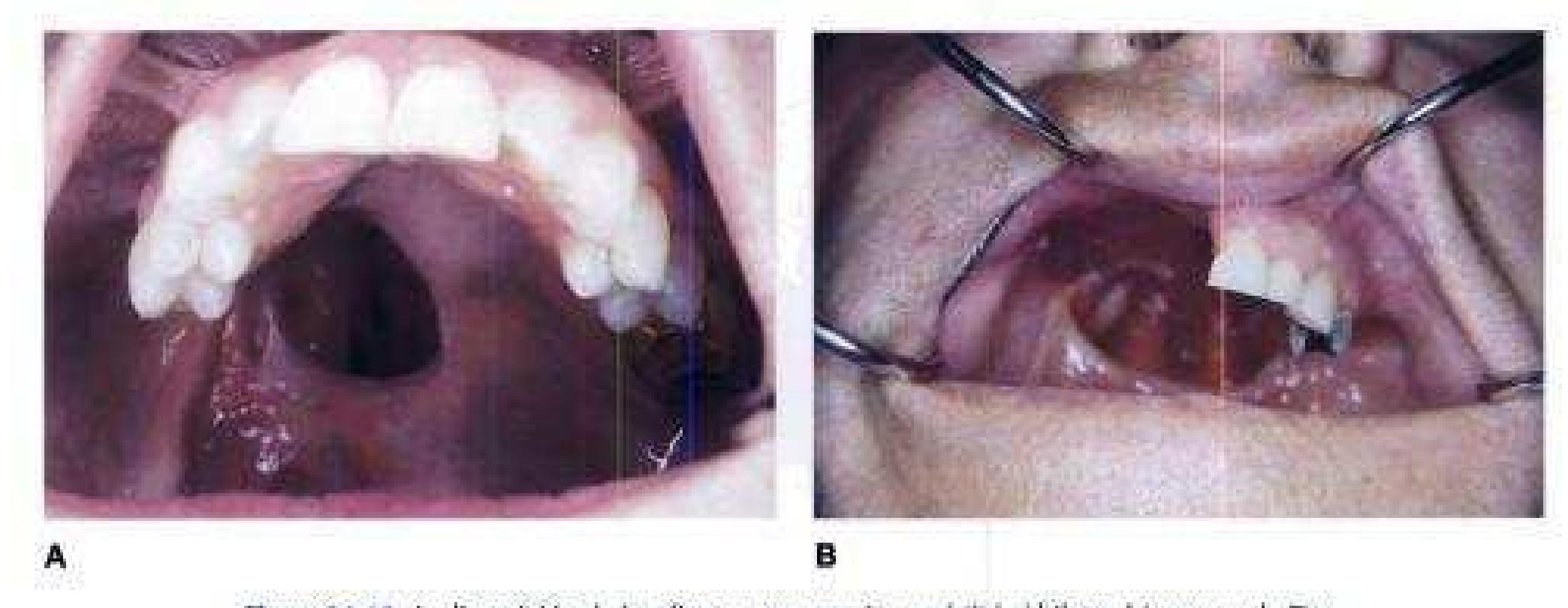 Mccracken Protesis Parcial Removible 11 Edicion www.academia.edu