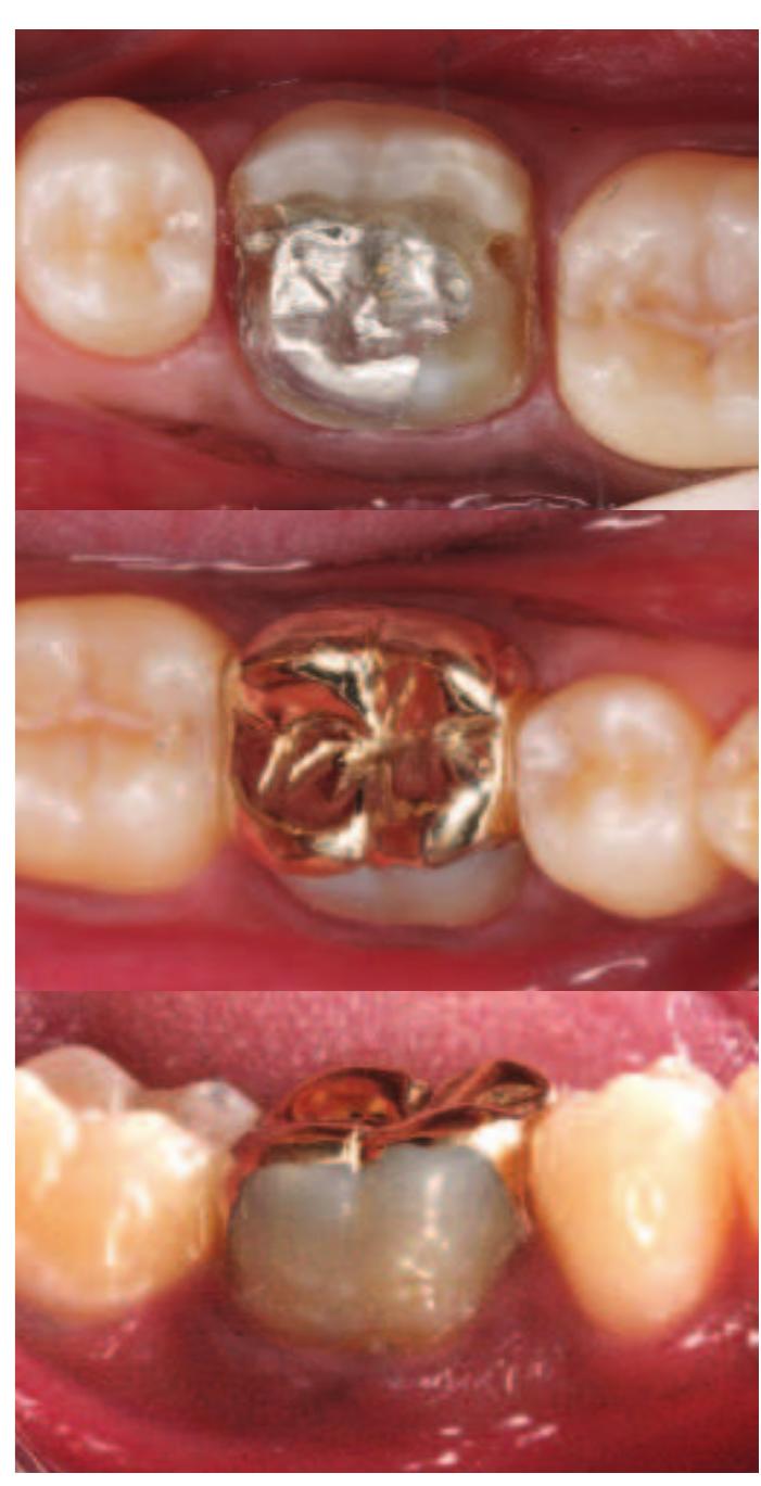 (PDF) Restoration of the root canal treated tooth