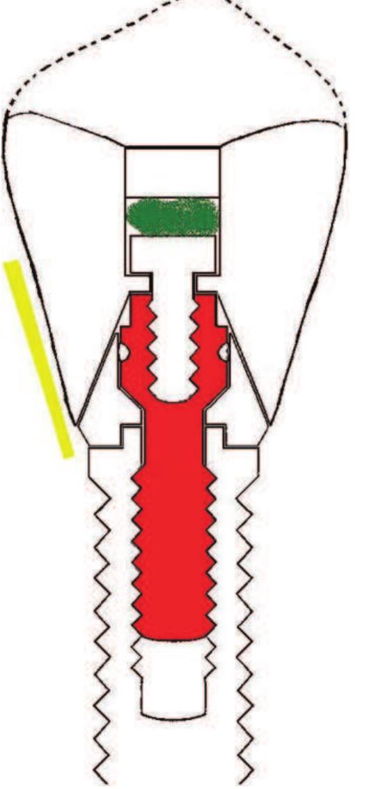 Schematic view of an implant and suprastructure showing the