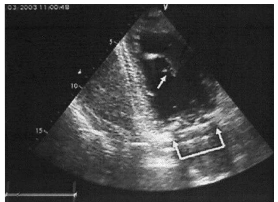 Tricular Figure 1 - from An unusual complication after chordal