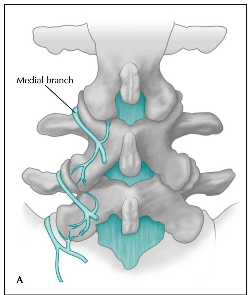 (PDF) Radiofrequency ablation for chronic pain control
