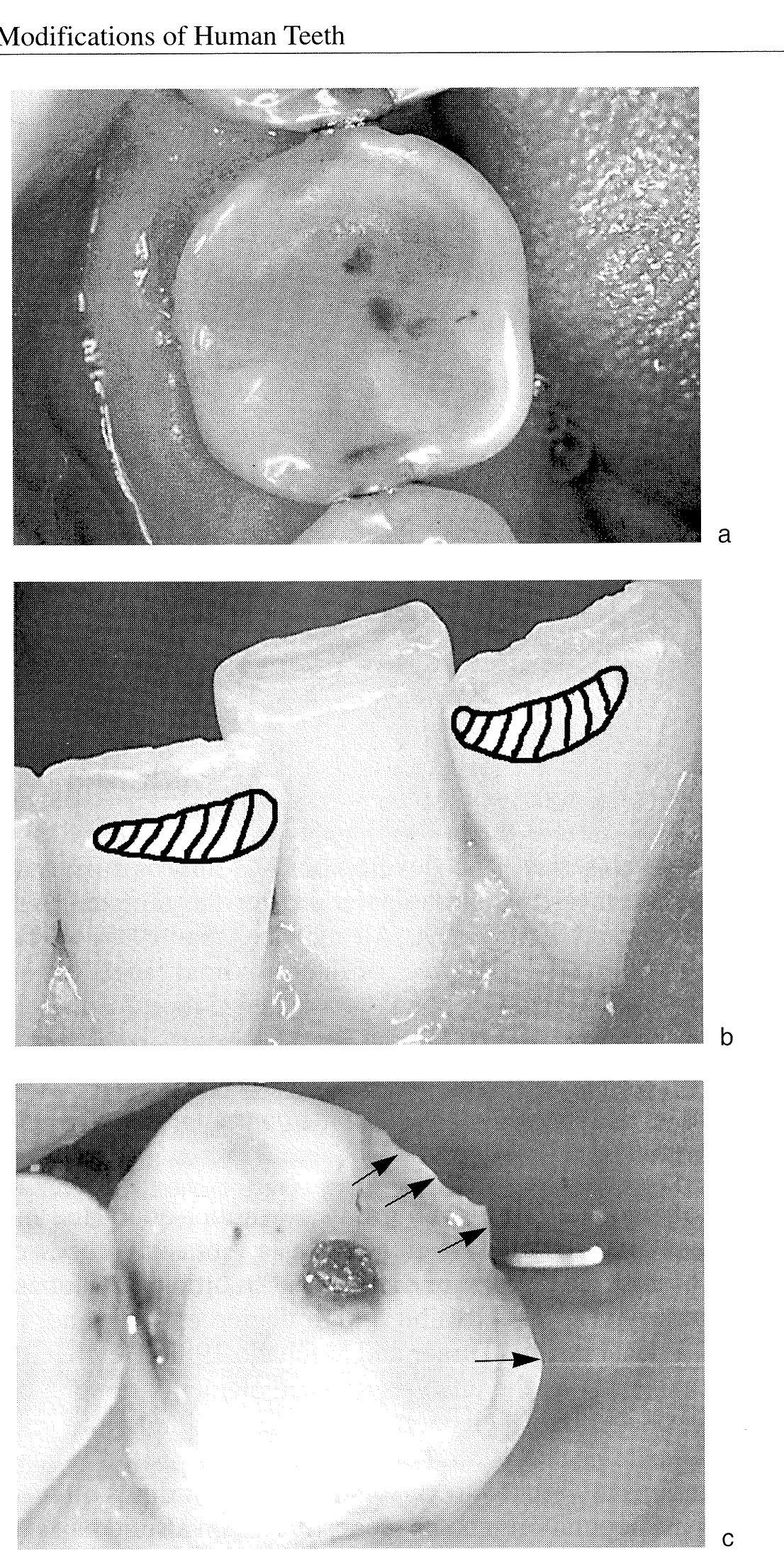 Teeth Modification A, b. modification of anterior teeth by third-hand