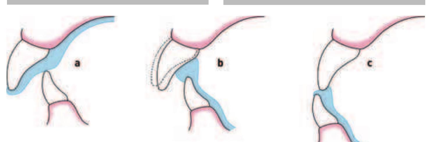Splint Verbindung (PDF) How to make a well-fitting stabilization splint