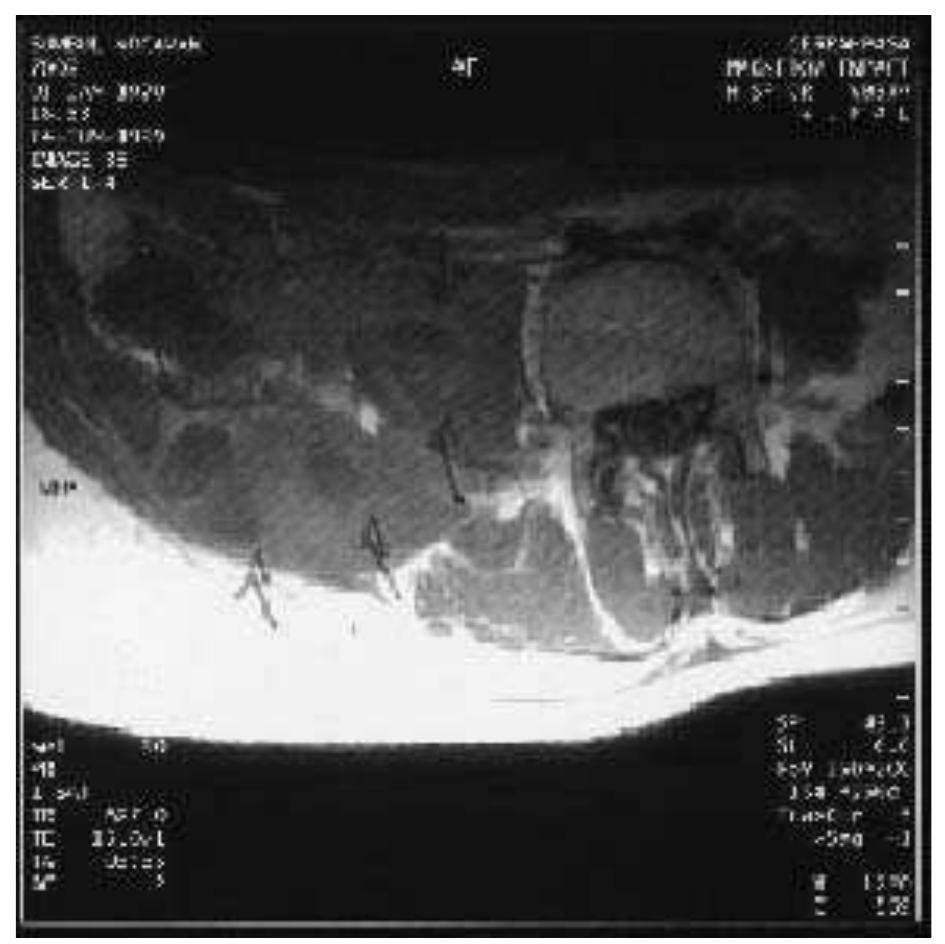 Muscle Abscess Mri (PDF) Primary Psoas Muscle Abscess Diagnosed and Treated During ...