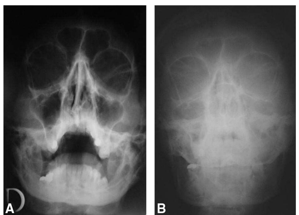 (PDF) Craniofacial Identification by Comparison of Antemortem and ...