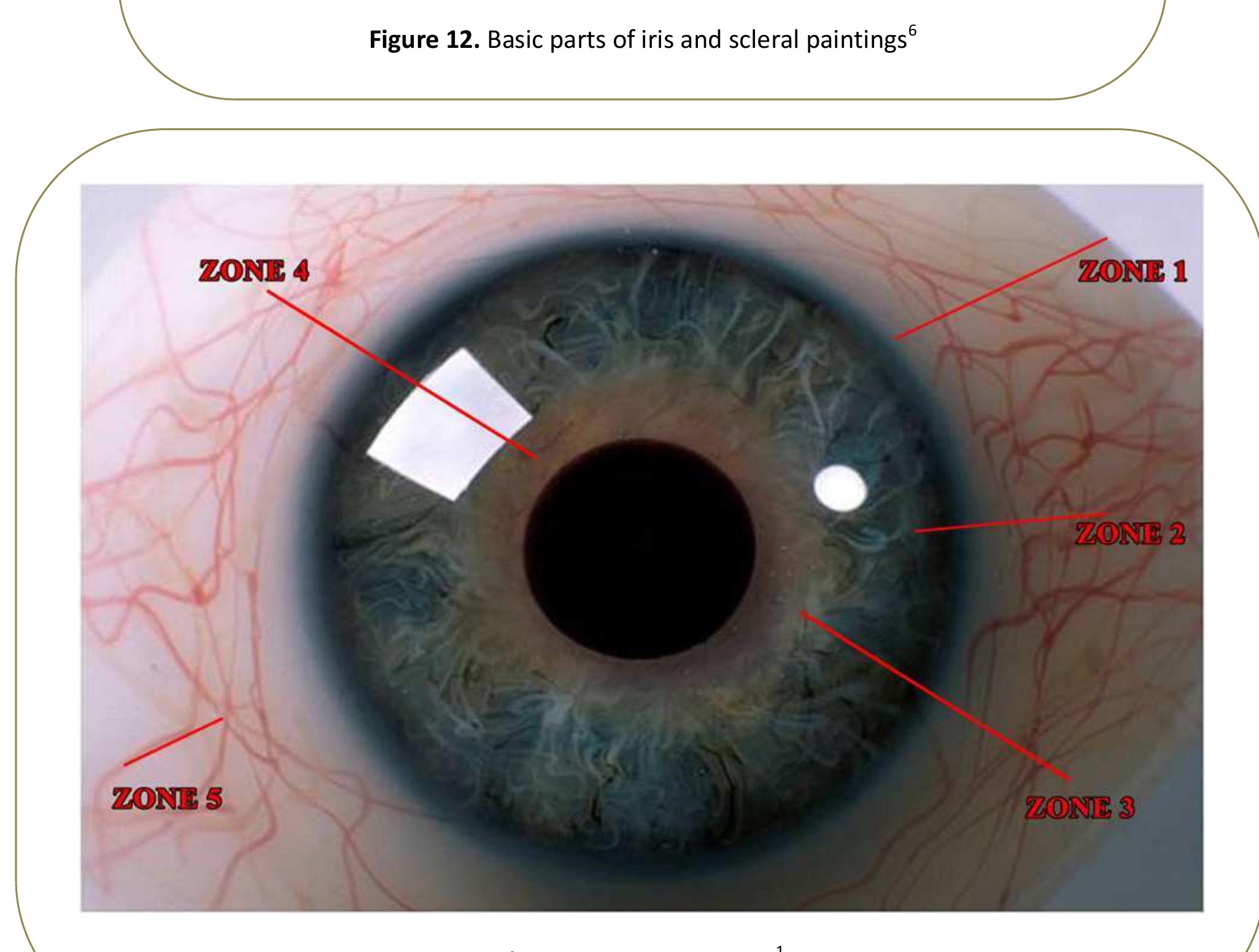 Figure 5 - Rehabilitation of an Ocular Defect- A Clinical
