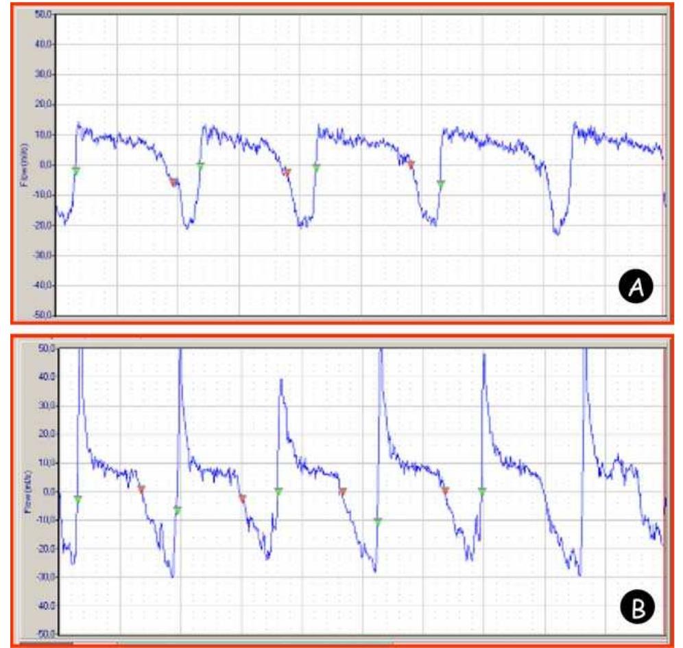 Boxy Spo2 Waveform Waveforms from the box pressure signal measured by